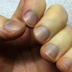 Blue Nails: Causes and Cure 2023